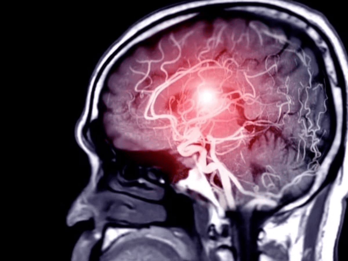 UCLA Stroke Drug Restores Movement After Stroke