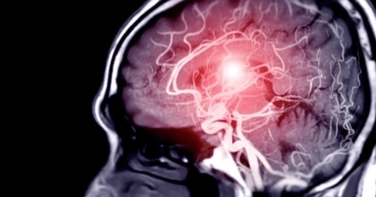 UCLA Stroke Drug Restores Movement After Stroke